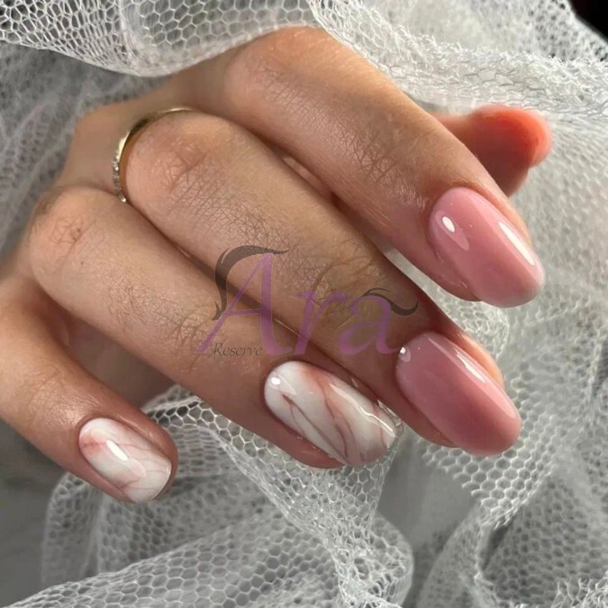 کاشت ژل 