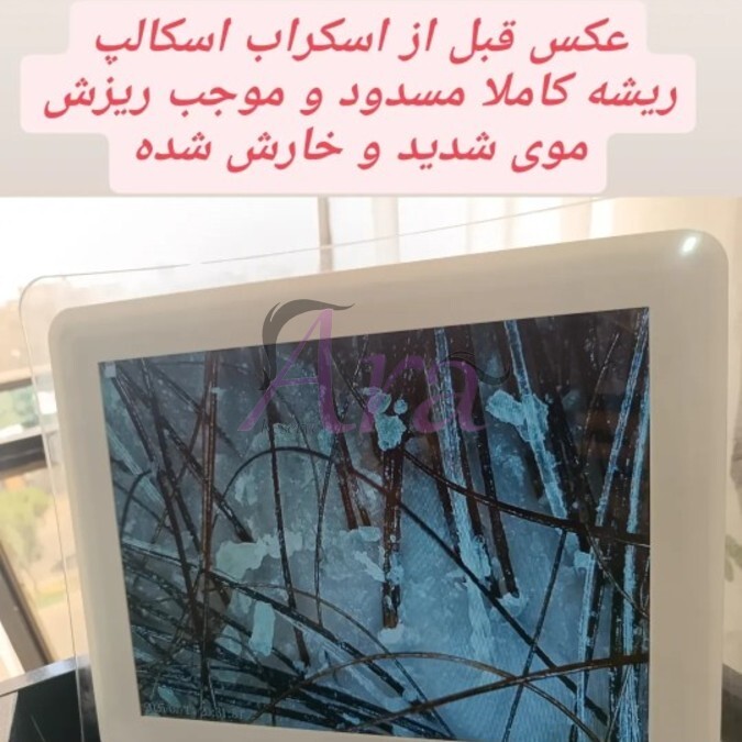 آنالیز کف سر